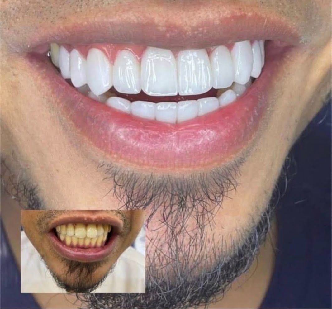 عدسات اللمونير