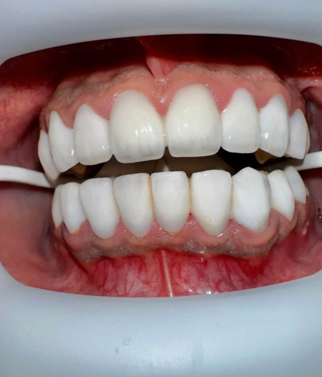 تركيبات الاسنان والعدسات التجميلية