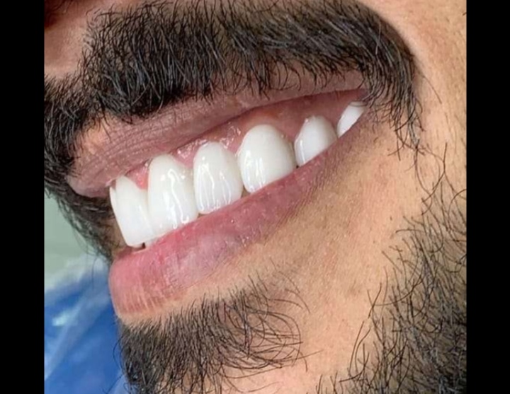 ابتسامة هوليود